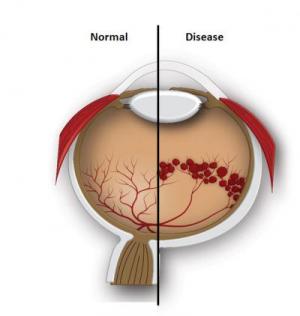 Omega-3 Fatty Acids Protect Against Blindness, Study Says